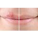 SoreFix Duo Patch + Prevent Set 2 Stuks