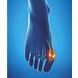 Epitact Hallux Valgus Beschermer Maat 42-45 1ST Epitact Hallux Valgus Beschermer Maat 42-45 1ST