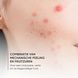 Louis Widmer Skinappeal Peeling Zonder Parfum 50ML Wang van gezicht met puistjes Louis Widmer Skinappeal Peeling Zonder Parfum 50ML Wang van gezicht met puistjes